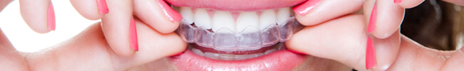 removable aligners